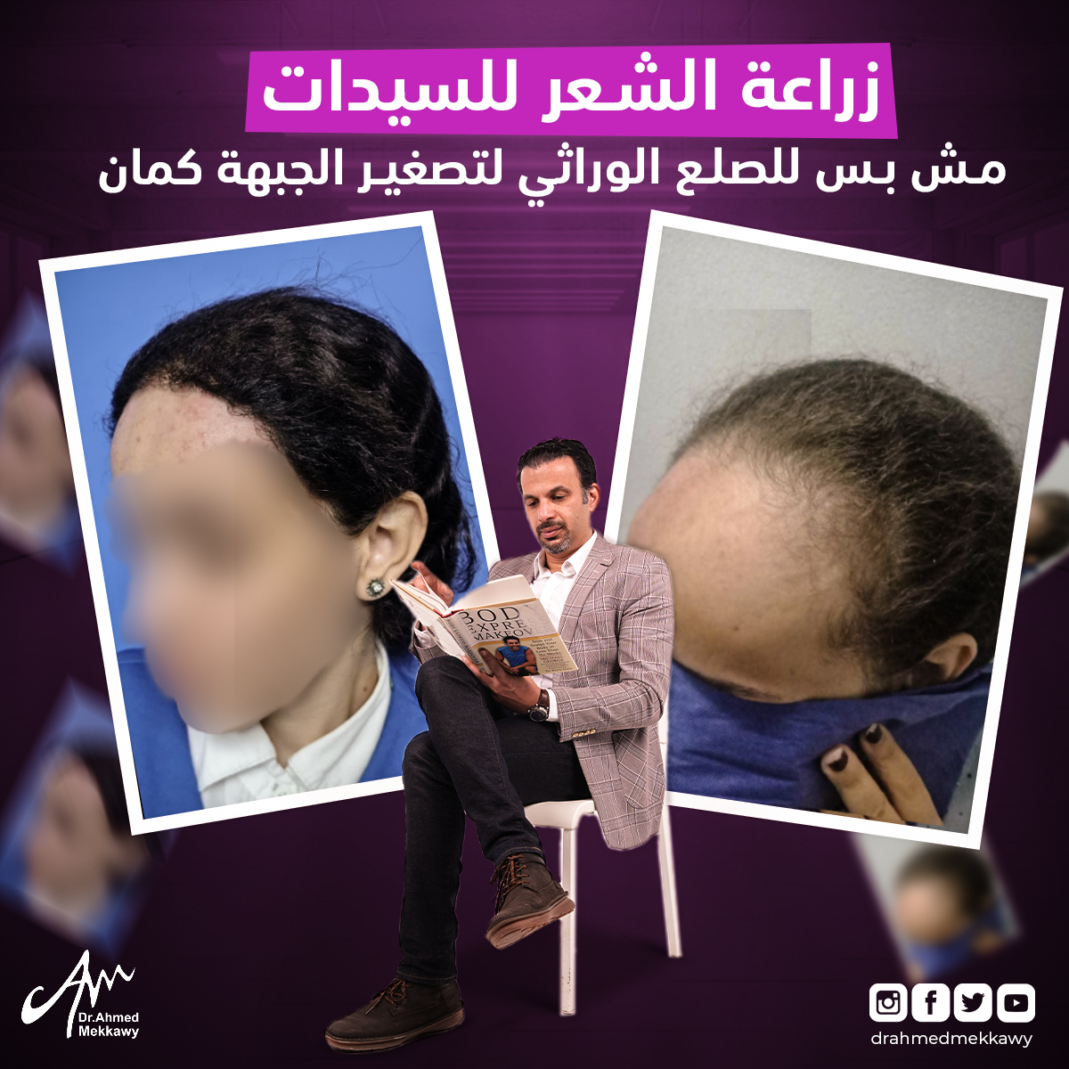 زراعة الشعر للسي